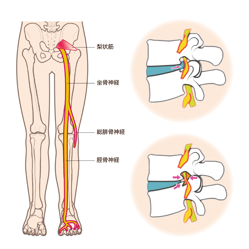 坐骨神経痛のイラスト