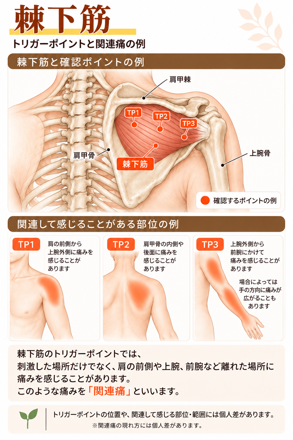 棘下筋のトリガーポイントと関連痛の例