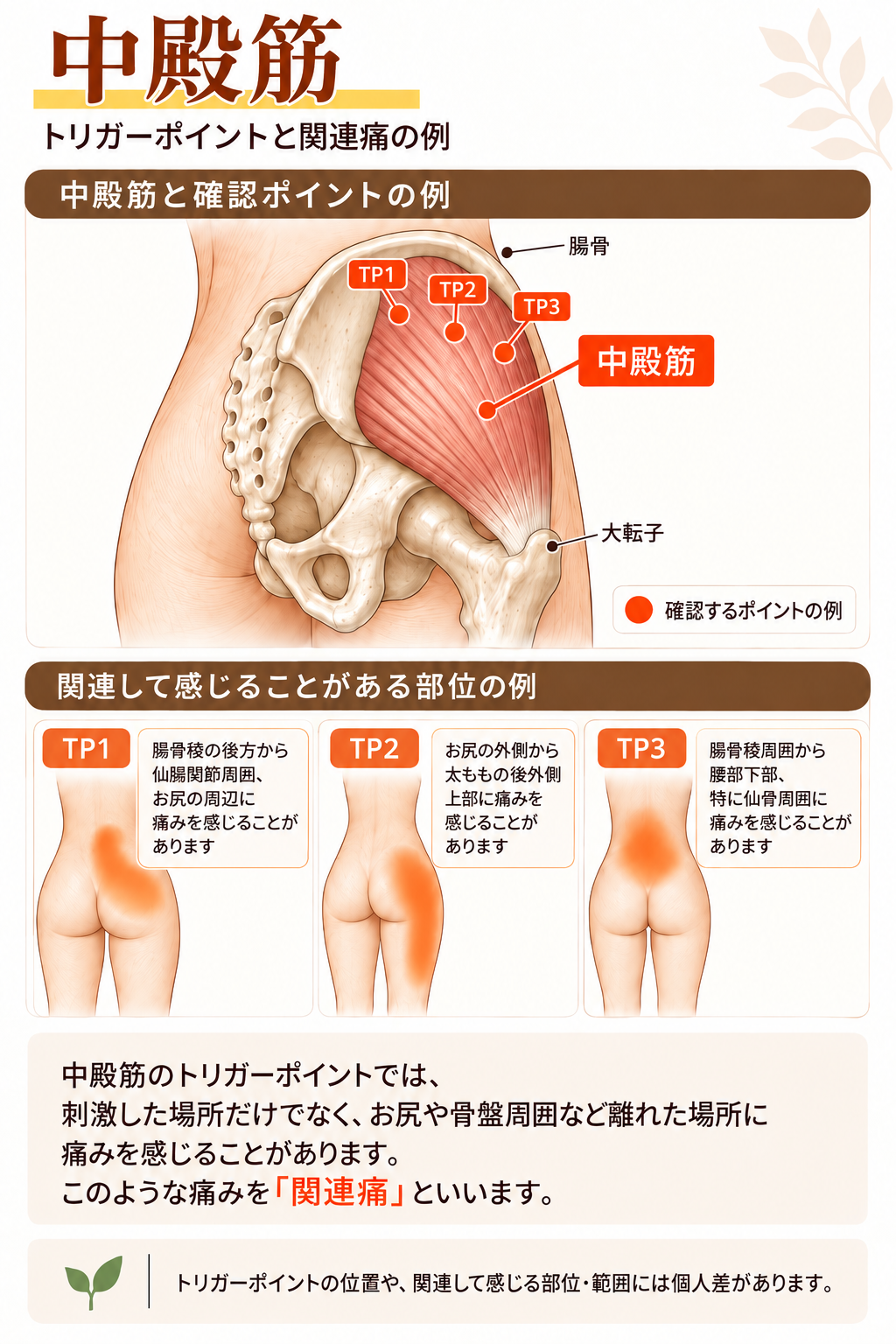 中殿筋のトリガーポイントと関連痛の例