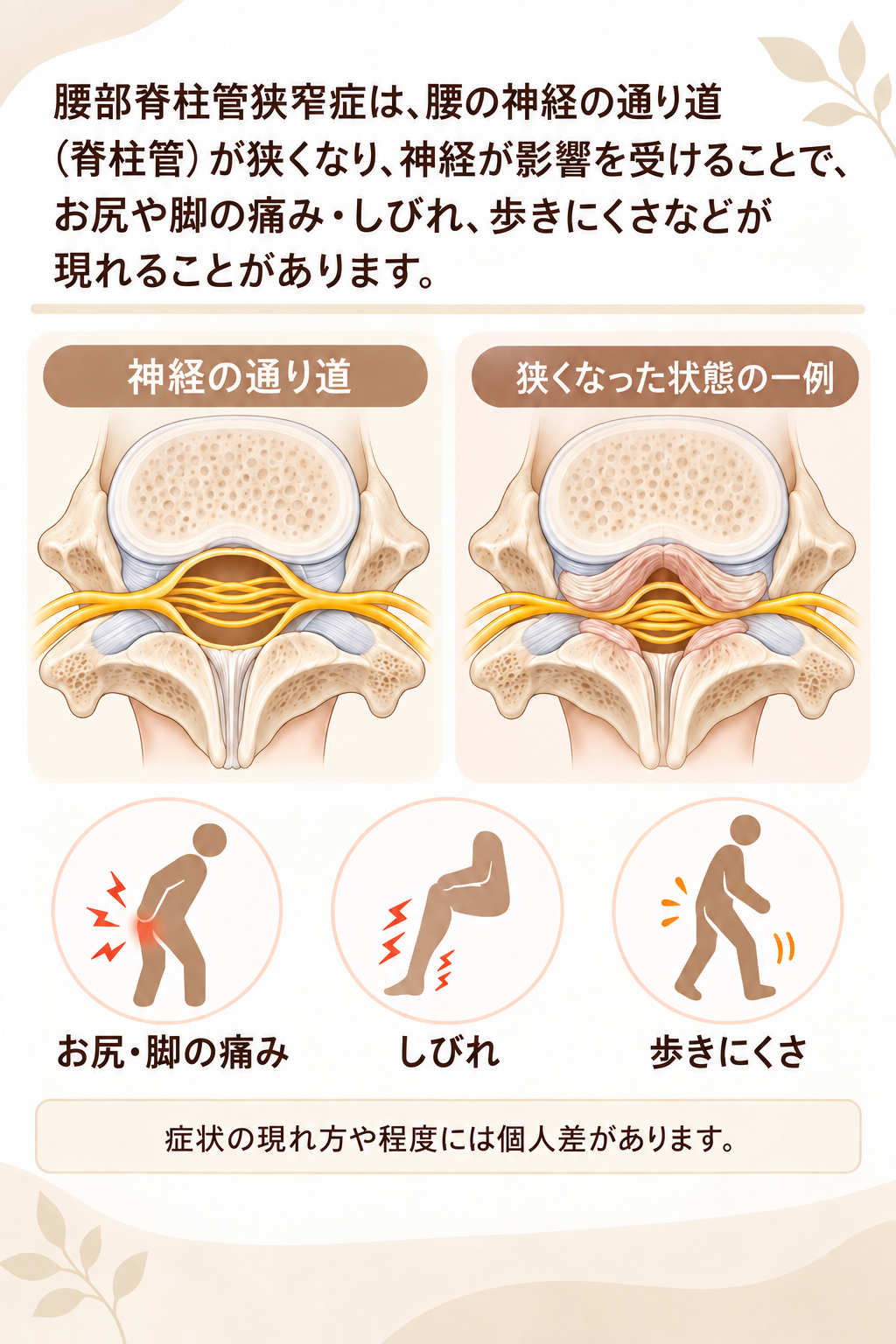 腰部脊柱管狭窄症の神経の通り道と狭くなった状態の説明図