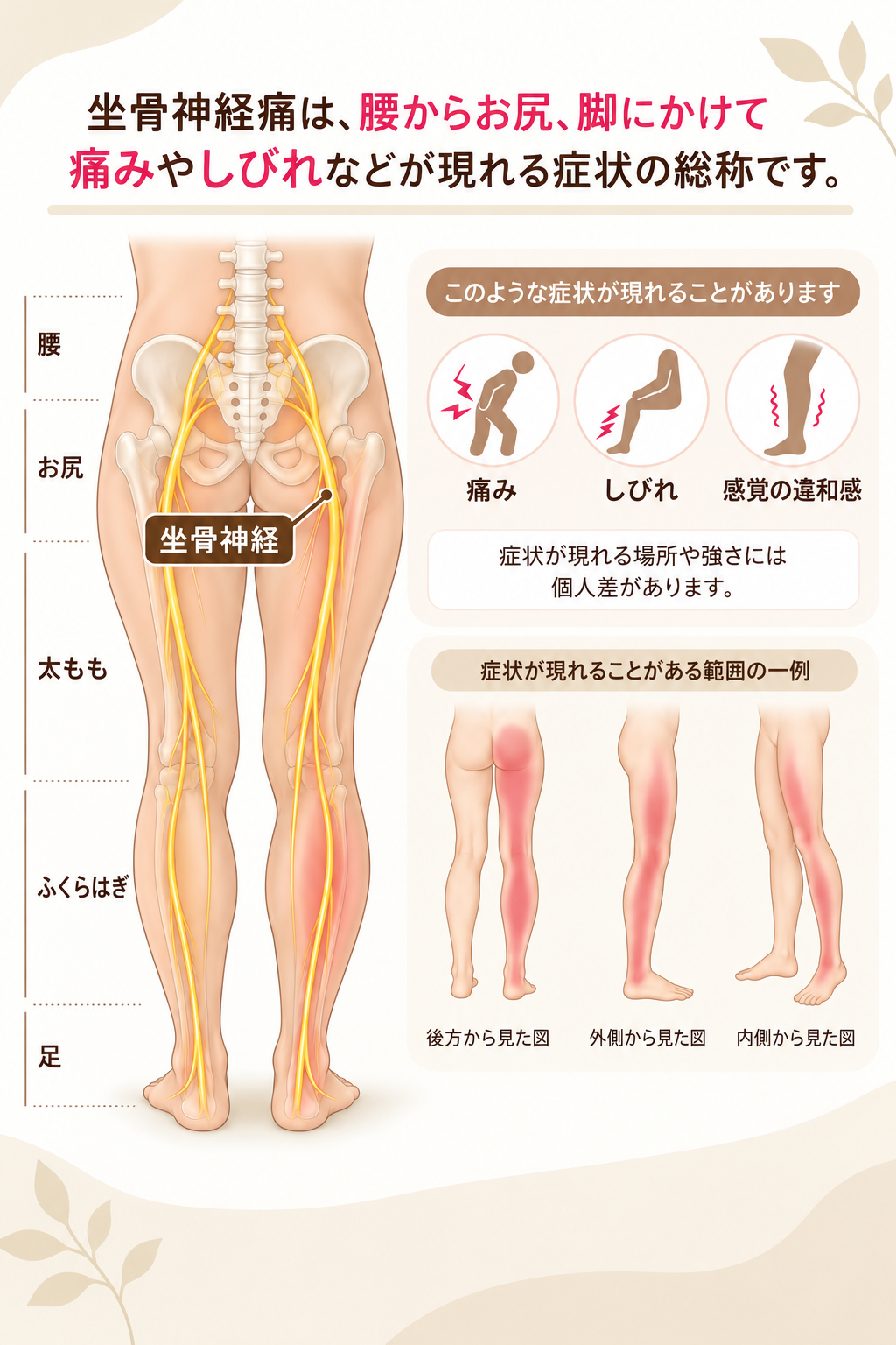 坐骨神経の走行と坐骨神経痛の症状が現れる範囲の説明図