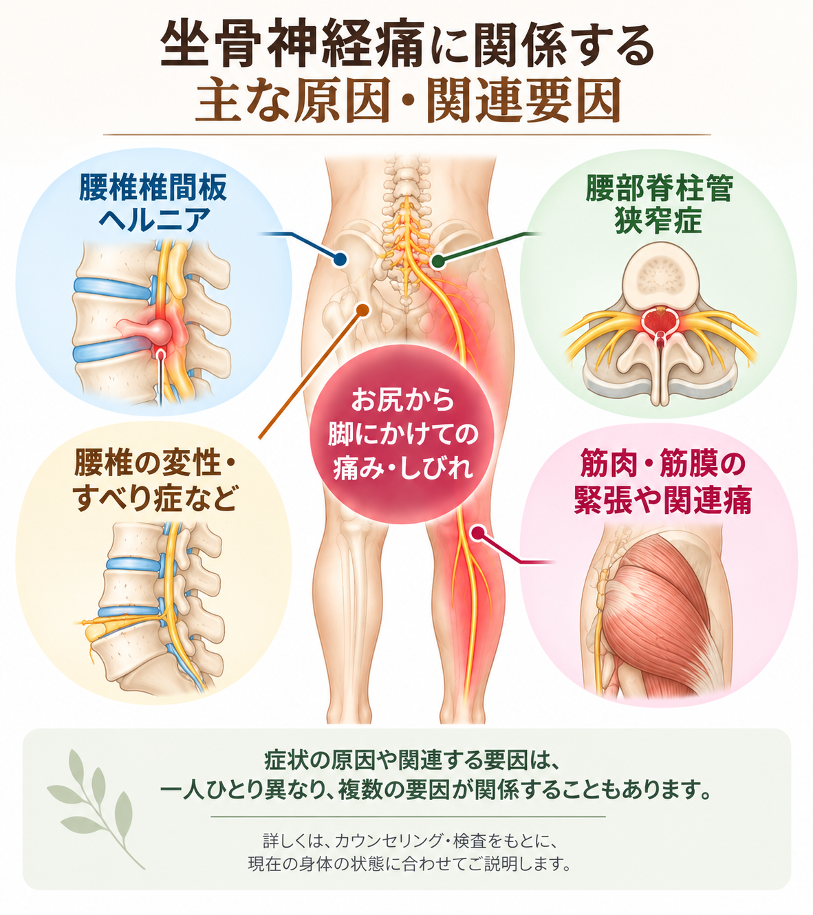 坐骨神経痛に関係する主な原因・関連要因の説明図